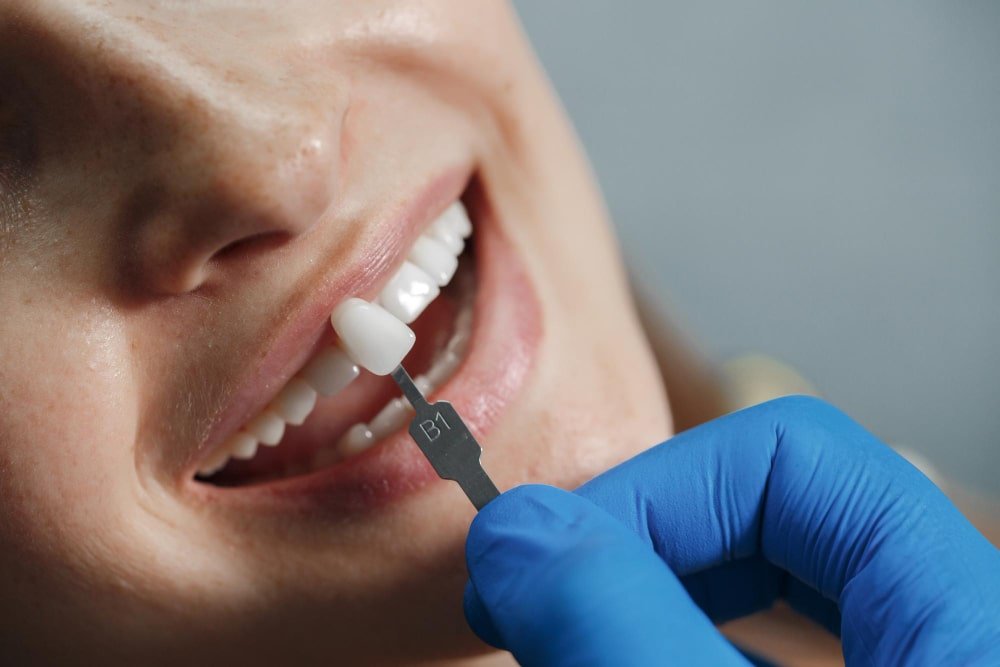 What is Teeth Bonding