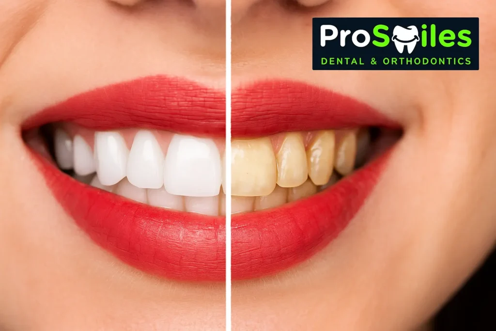 teeth whitening procedures