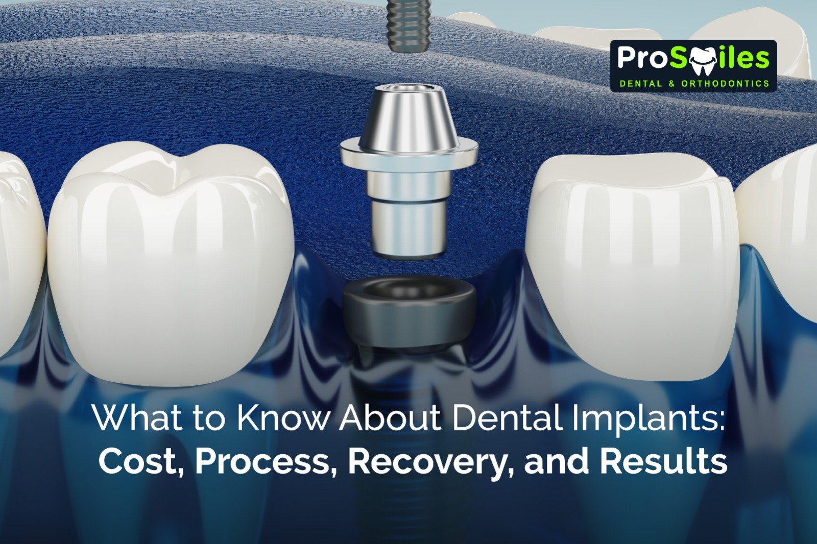 What to Know About Dental Implants: Cost, Process, Recovery, and Results