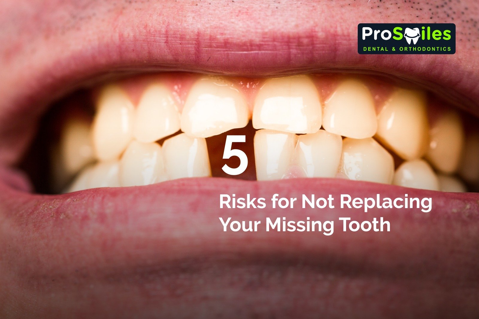 5 Risks of Not Replacing Your Missing Tooth