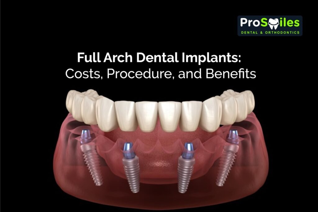 Full Arch Dental Implants