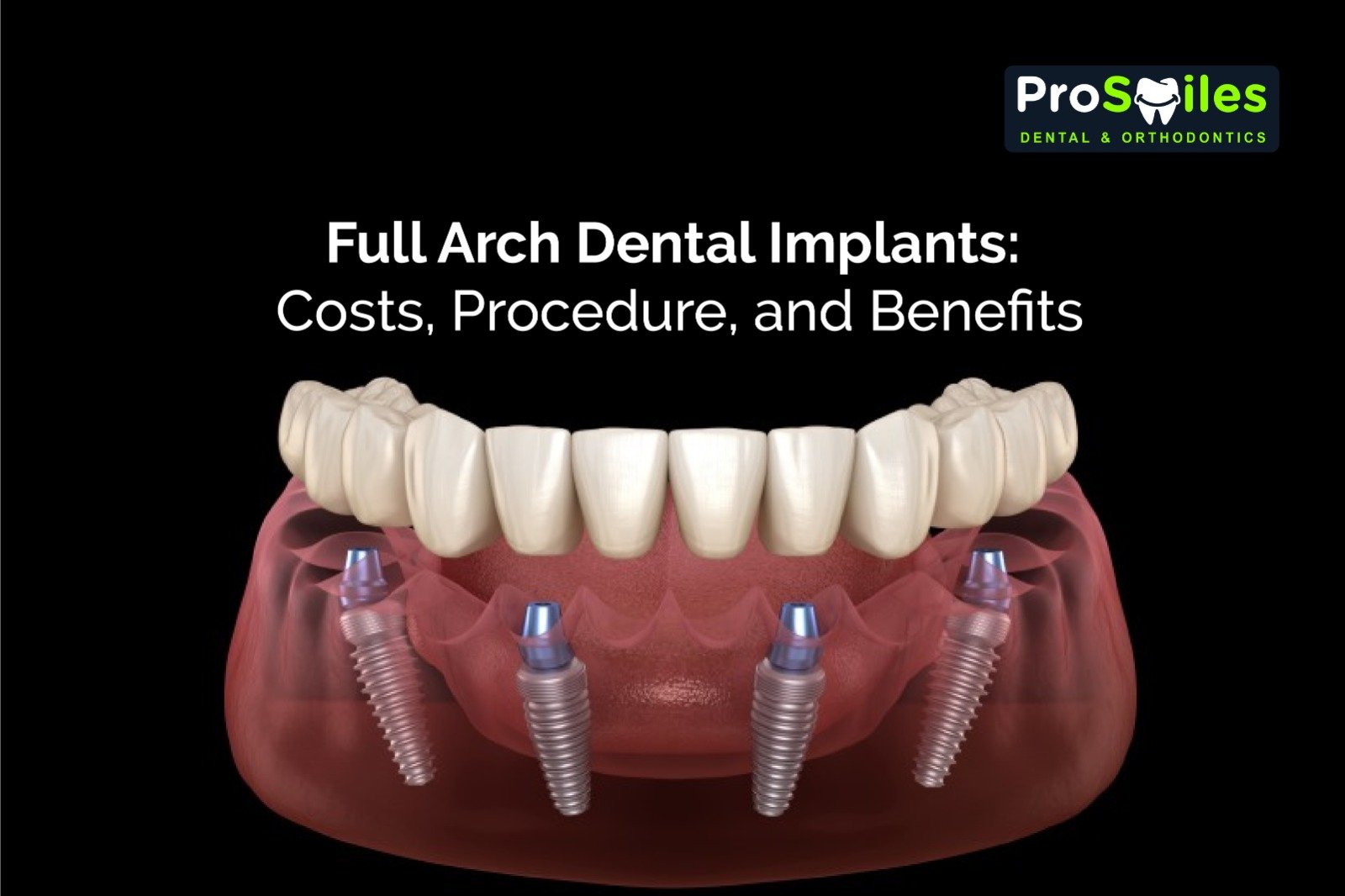Full Arch Dental Implants