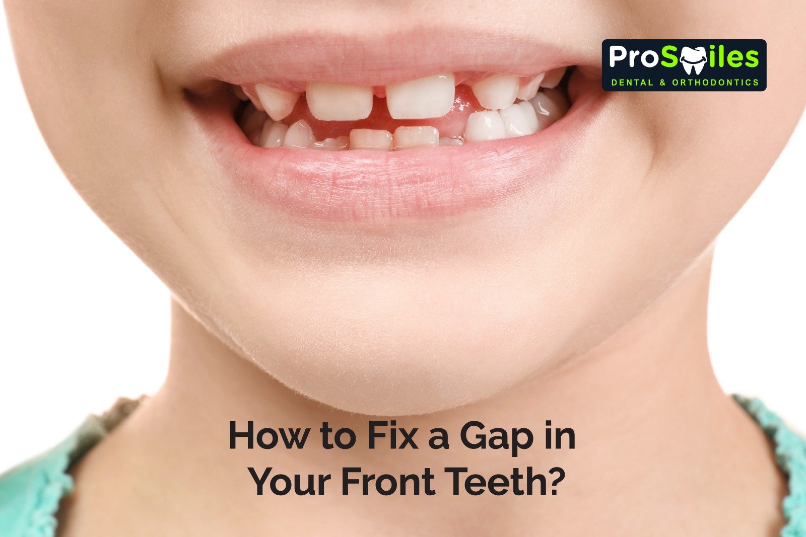 How to Fix a Gap in Your Front Teeth