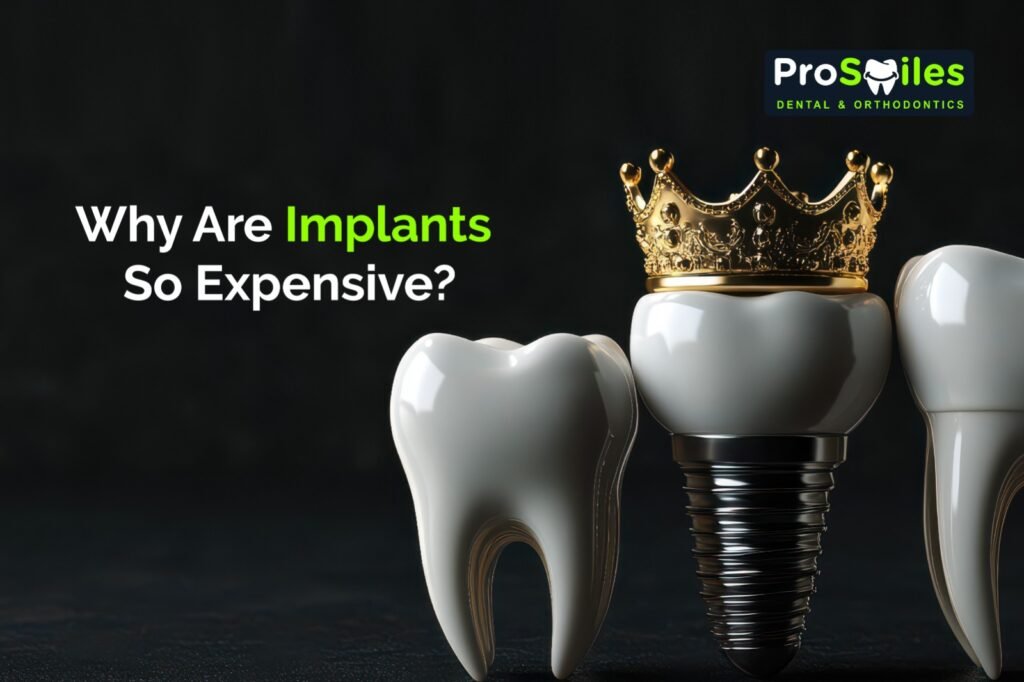 Why Are Implants So Expensive