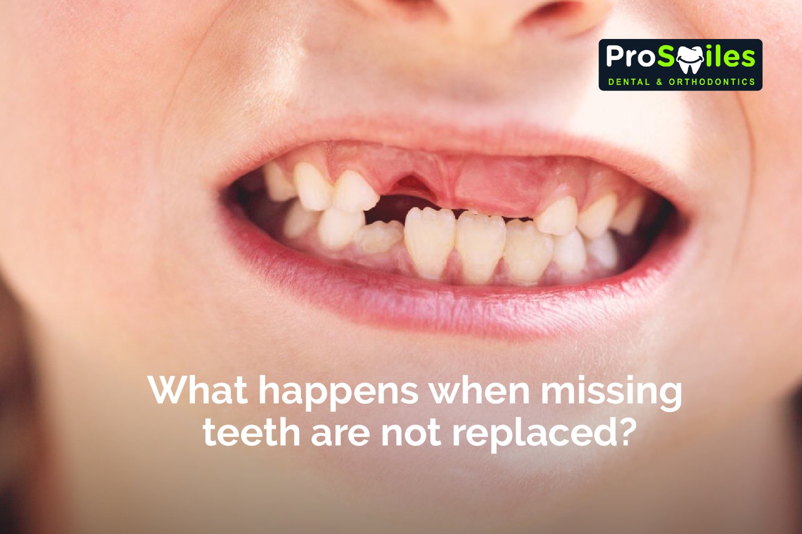What happens when missing teeth are not replaced?