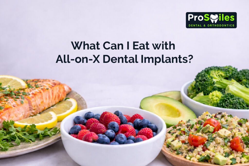 All-on-X Dental Implants