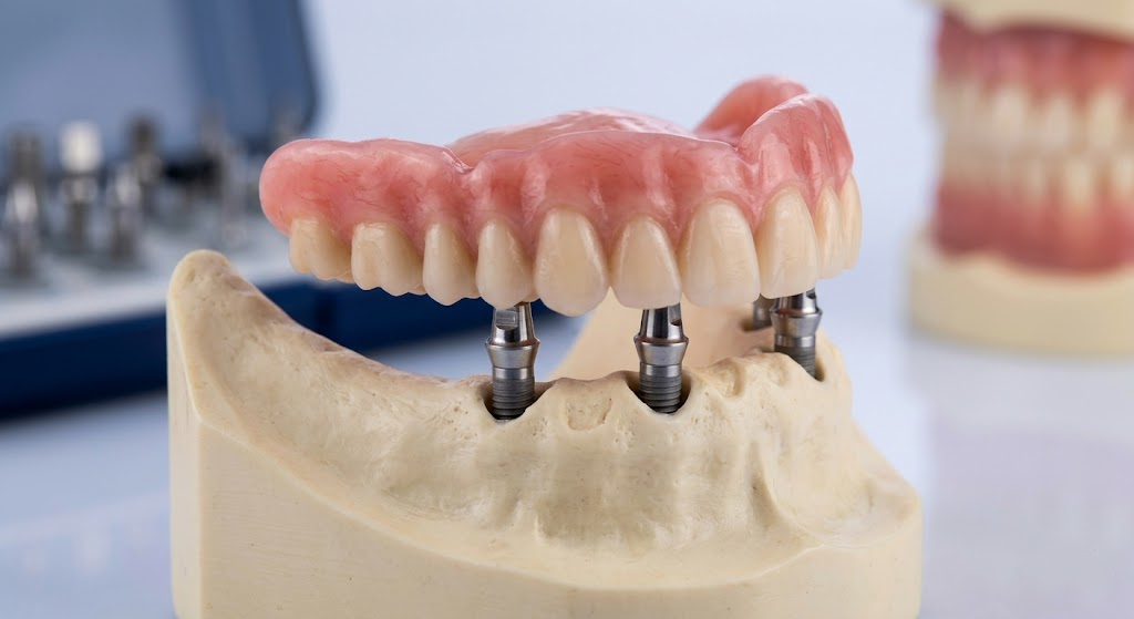 Implant Dentures