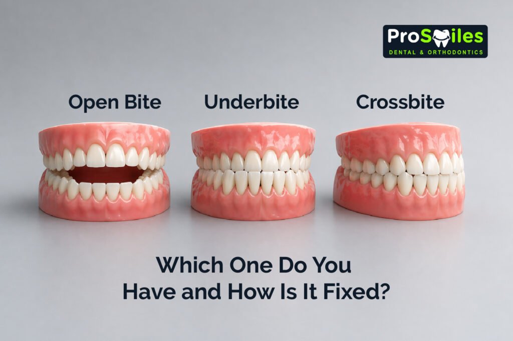 Open Bite, Underbite, Crossbite