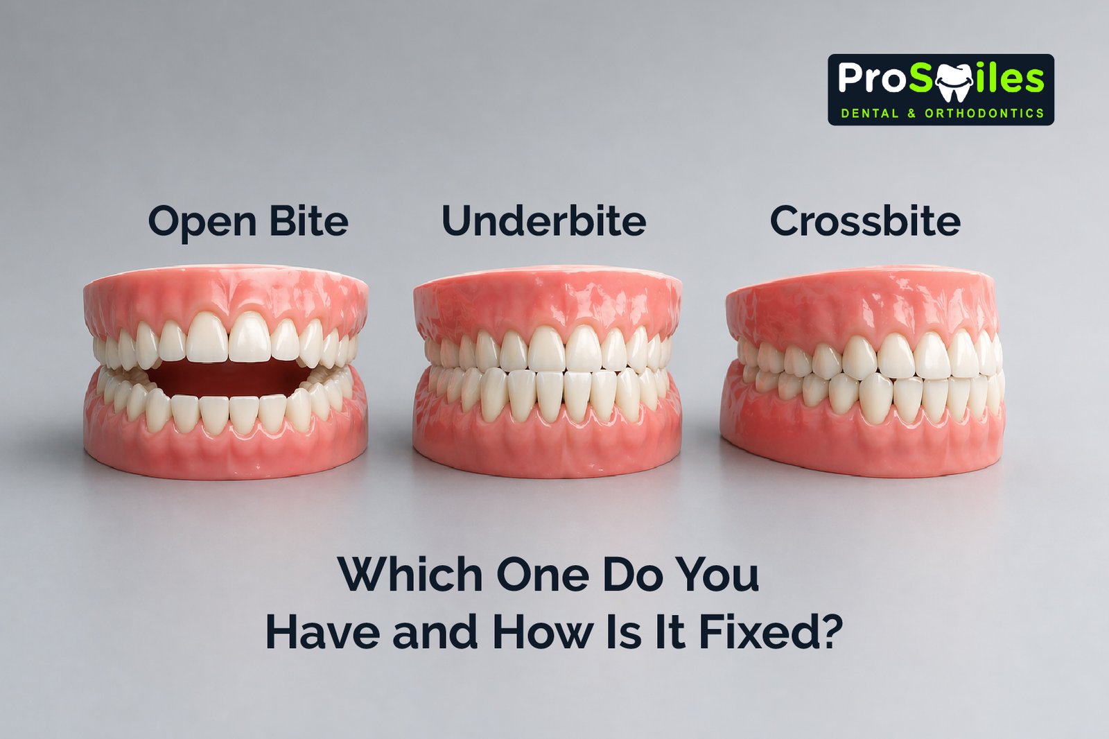 Open Bite, Under bite, Cross bite: Which One Do You Have and How Is It Fixed?